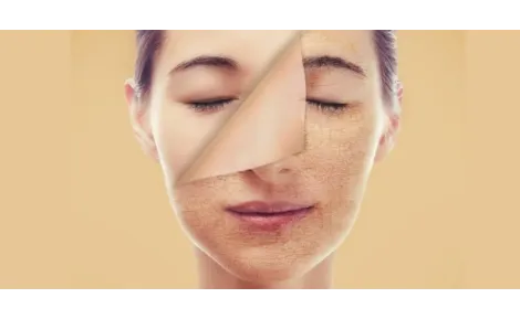 Čo robiť ak ste to prehnali s exfoliáciou (ako ja)