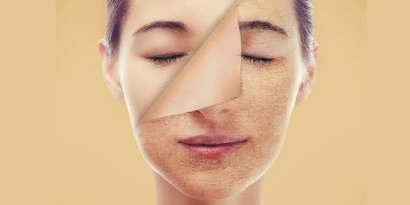 Čo robiť ak ste to prehnali s exfoliáciou (ako ja)