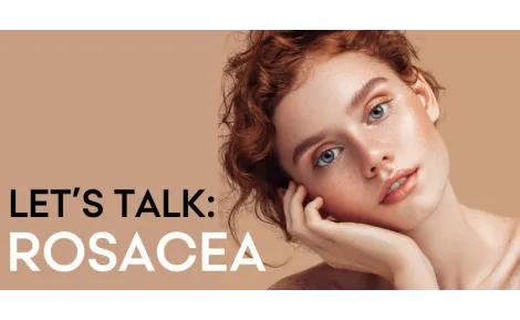 Lets talk: Rosacea