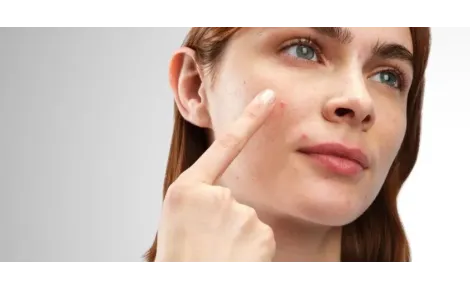 Dokonalá novinka od The Ordinary -  náplasti na akné Sulfur